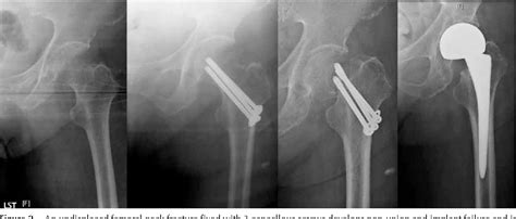 Figure 2 From Cancellous Screw Fixation For Undisplaced Femoral Neck