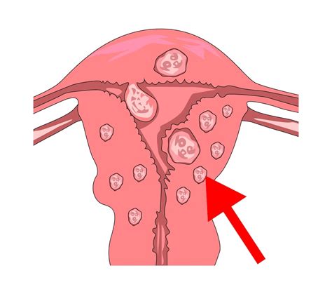Myoma Fibroid — Causes Symptoms Treatment