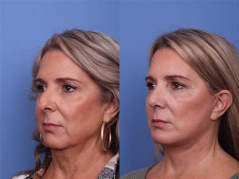 Facelift Before And After Pictures Case 457 Scottsdale Az Hobgood Facial Plastic Surgery