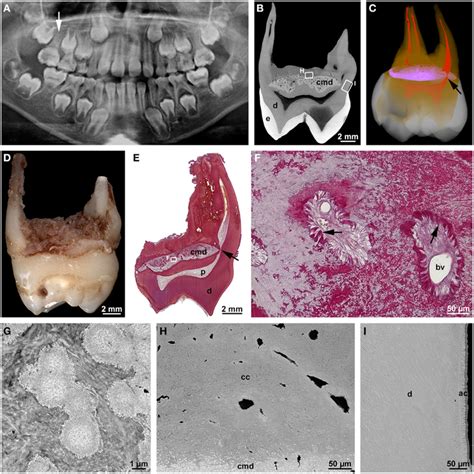 Frontiers Malformations Of The Tooth Root In Humans