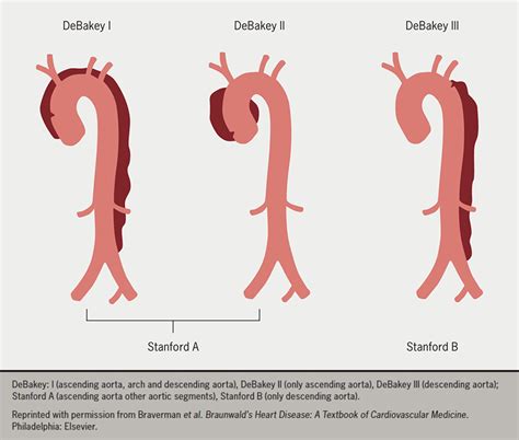 Acute Aortic Dissection Aad A Lethal Disease The Epidemiology