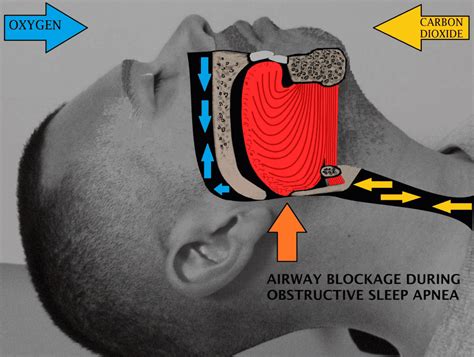 how to treat sleep apnea naturally at home sleep care online