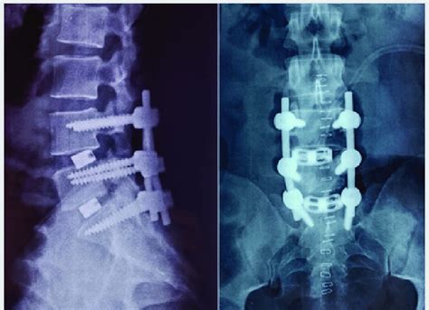 Plain Radiograph Of Lumbosacral Spine Showing Double Level L3 L4 And