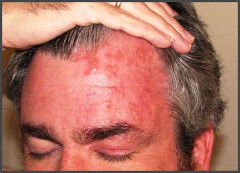 Shingles On Forehead Pictures Shingles Expert