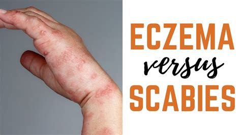 Scabies Vs Eczema Causes Symptoms Treatments YouTube