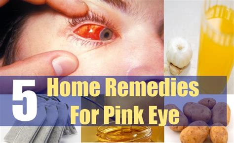 5 Home Remedies For Pink Eye Natural Home Remedies And Supplements