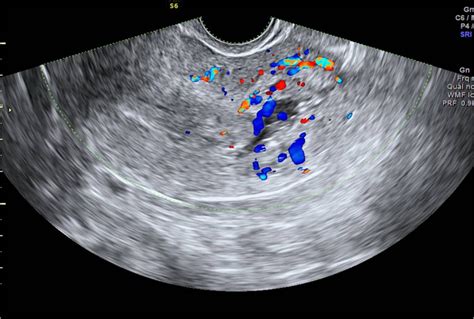 Cornual Ectopic Pregnancy Laparoscopic Management Step By Step Bmj