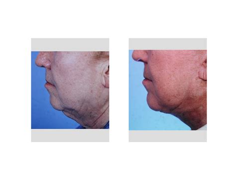 Chin Implant In Neck Contouring Dr Barry Eppley Indianapolis Explore