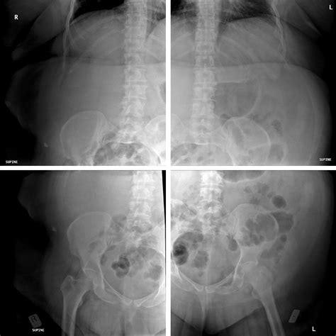 Abdominal Radiography Of The Morbidly Obese Patient Wikiradiography