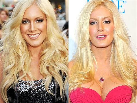Heidi Montag Celebrity Plastic Surgery Disasters Pictures Cbs News