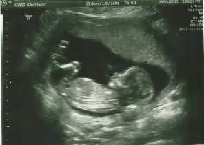 Gender Nub Guesses 131 Nt Scan Ultrasound Could It Still Be A Girl