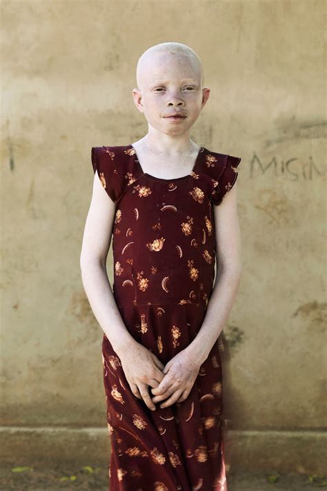 Albino Children Being Hunted Tanzania Photo Series