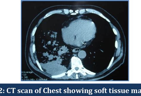 Figure 2 From A Rare Case Of Small Cell Lung Cancer With Skin