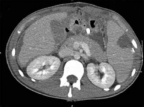 Horizontal Section Of Ct Abdomen Showing Splenic Infarct