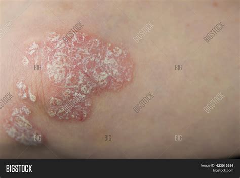 Acute Psoriasis On Image And Photo Free Trial Bigstock