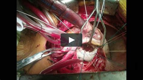 Open refers to the chest being. Open Heart Surgery on Vimeo