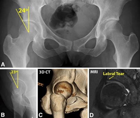 A A Pelvic Anteroposterior Radiograph Showing 24 In Lateral