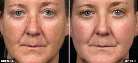 Fractional Skin Resurfacing Laub Dermatology