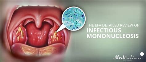 A Detailed Review Of Infectious Mononucleosis Mono Medonlinepk