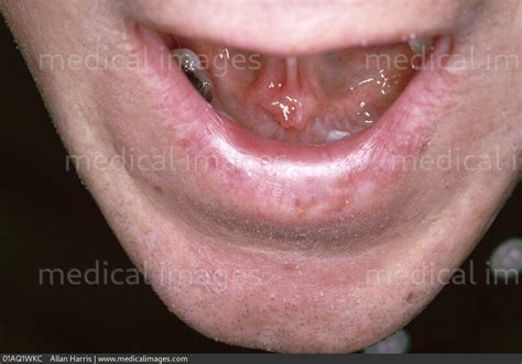 Stock Image Oral Medicine Submandibular Gland Swelling Large Lump