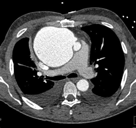 Aneurysm Aortic Root Radiology Imaging Case Study