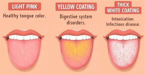 لون اللسان يدل على حالتك الصحية