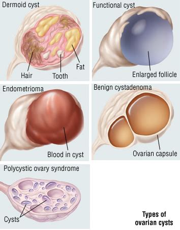 Imaging tests, such as a breast ultrasound or mammogram; Cysts (Overview) - Harvard Health