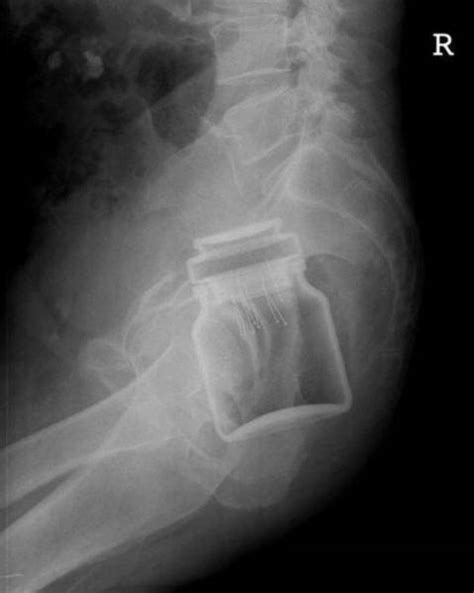 X Rays Of Objects Stuck In Really Strange Places 30 Pics