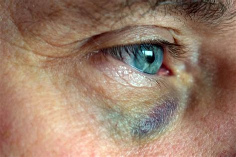 Black Eye What Causes It And How To Treat It