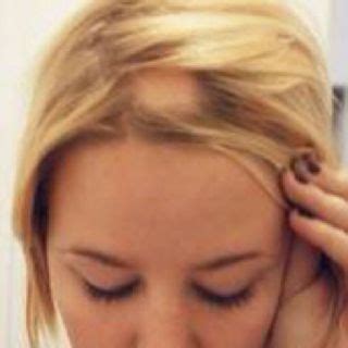 Hair loss also has a genetic basis. Tinea Capitis: Ringworm of the Scalp | Beautifully Styled ...