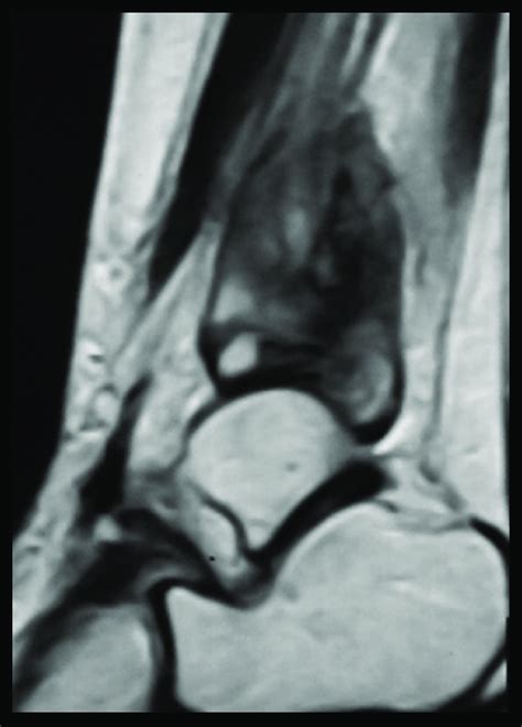 T2 Weighted Images Of The Distal Tibial Metaphysis Showed The Distal