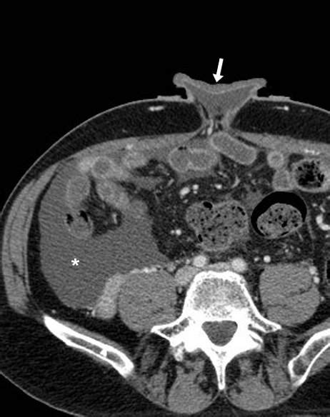 Spontaneous Leakage Of Ascites From Umbilical Hernia In Alcohol Related