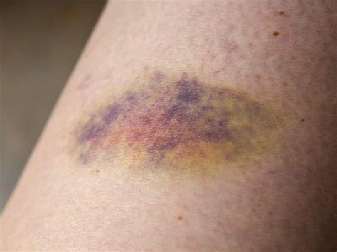 Bruising Easily 7 Possible Causes