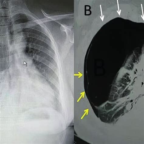 Posteroanterior Chest Roentgenogram A Shows Giant Radiolucent Bullae