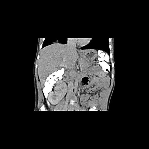 Right Kidney Malrotation Radiology Case Contributed By Dr Arthur