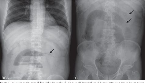 Figure 2 From Accuracy Of Plain Abdominal Radiography In The Differentiation Between Small Bowel