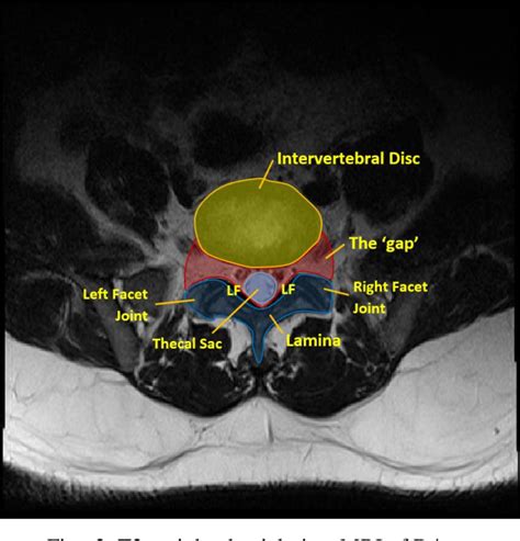 Axial T2 Mri Lumbar Spine Hot Sex Picture