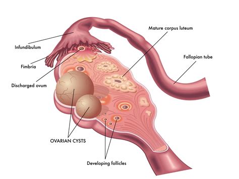 Types Of Cysts In Women