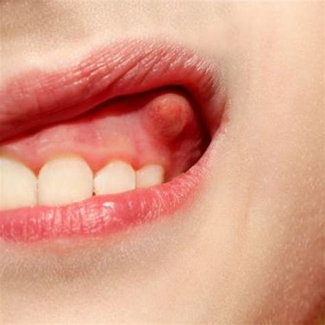 Tooth Abscess Stages Symptoms Pictures Treatment