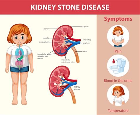 Free Vector Kidney Stones Disease Cartoon Style Infographic