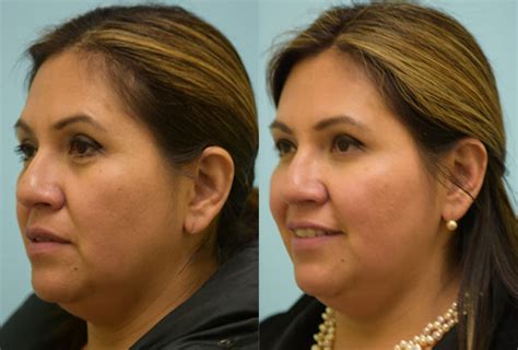 Dallas Botox Before And After Photos Plano Plastic Surgery Photo