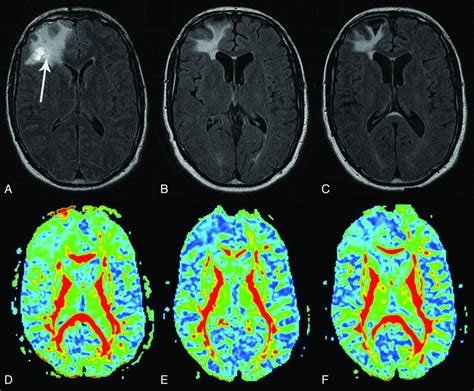 Long Term White Matter Changes After Severe Traumatic Brain Injury A 5