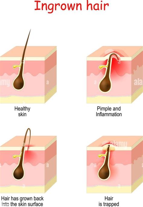 Top 48 Image How To Relieve Itchy Pubic Hair Thptnganamst Edu Vn