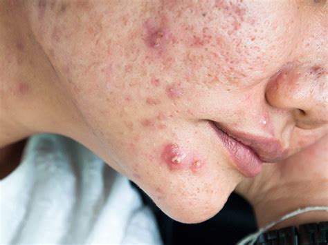 How To Deal With Cystic Acne