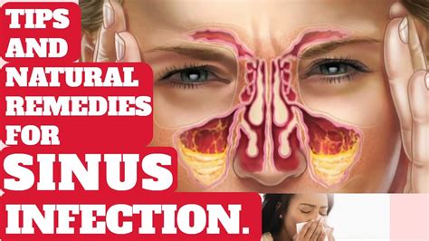 Tips And Natural Remedies How To Treat Sinus Infection Youtube