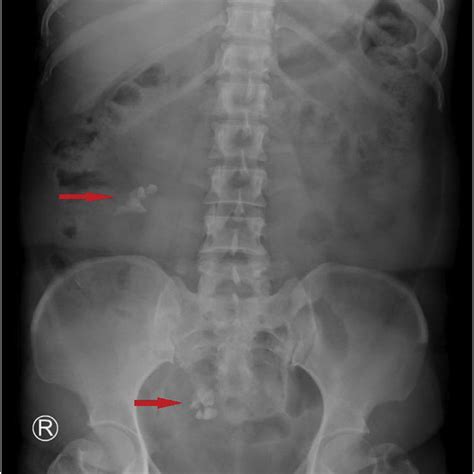 Ct Abdomen And Pelvis Showed An Absence Of Urinary Stone And Confirmed