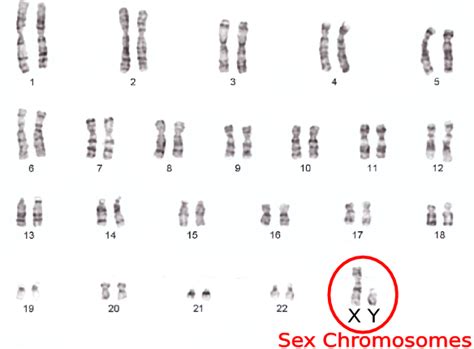 Sex Chromosome Disorders Sex Chromosome Abnormality Disorders