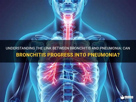 Understanding The Link Between Bronchitis And Pneumonia Can Bronchitis