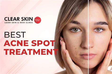 Discover The Best Acne Spot Treatment For Clear Skin Expert