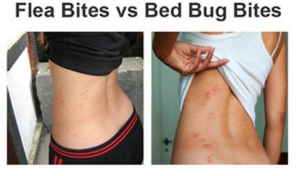 Flea Bites Humans Pictures